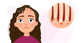 Read more about the article 头皮屑！“雪花纷飞”怎么办？